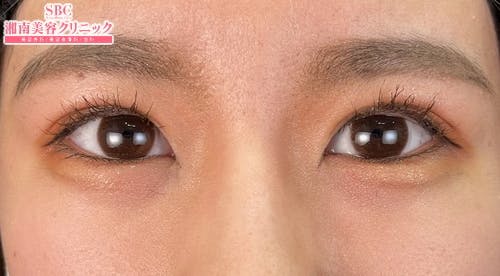 【女性・目元】線留めクロス二重術_after