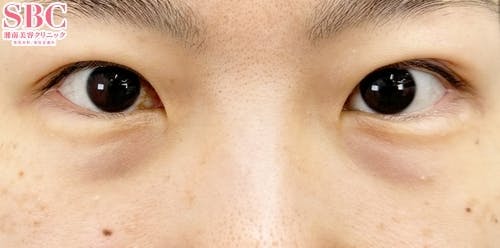 【30代女性・目元】目の下の切らないクマ・たるみ（ふくらみ）取り、ナチュラル脂肪注射ナノリッチ_before
