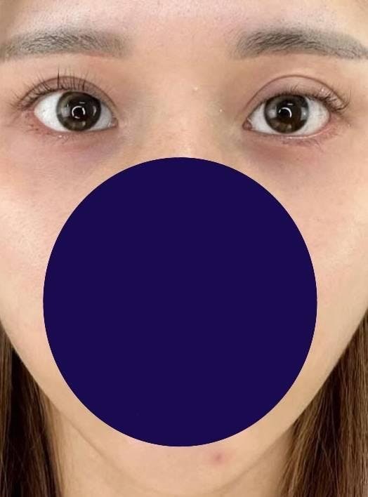 TCB東京中央美容外科 小倉院で二重整形・目元整形：目尻切開を受けたりゃんさんの写真