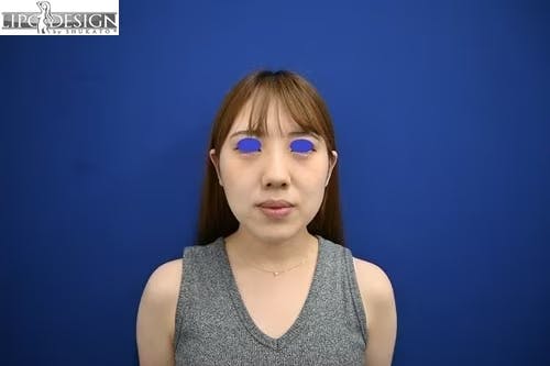 【24歳女性・小顔】バッカルファット_after