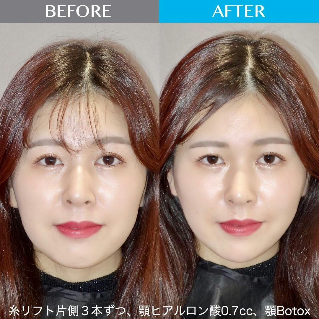 【女性・輪郭】糸リフト、顎ヒアルロン酸、顎ボトックス_before_aftar
