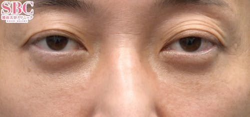 【目元】目の下の切らないクマ・たるみ（ふくらみ）取り、ナチュラル脂肪注射コンデンスリッチ、ナチュラル脂肪注射ナノリッチ_aftar