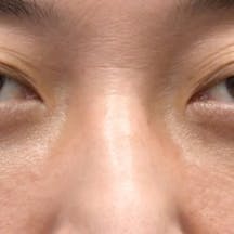 【目元】目の下の切らないクマ・たるみ(ふくらみ)取り、ナチュラル脂肪注射コンデンスリッチ、ナチュラル脂肪注射ナノリッチ_aftar