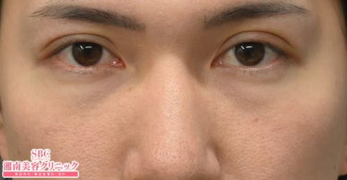【20代男性・目元】目の下の切らないクマ・たるみ（ふくらみ）取り ナチュラル脂肪注射コンデンスリッチ ナチュラル脂肪注射ナノリッチ_before
