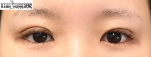 【29歳女性・目元】グランドループ法_justafter