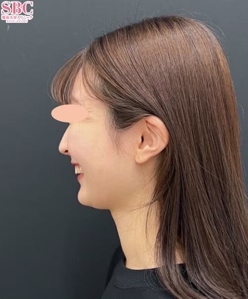 【20代女性・顔】根こそぎVASER脂肪吸引、シークレットリフト_before