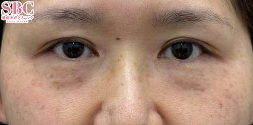 【女性・目の下】ナチュラル脂肪注射コンデンスリッチ、ナチュラル脂肪注射ナノリッチ、目の下の切らないクマ・たるみ（ふくらみ）取り_before