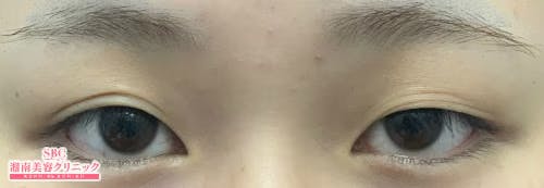 【女性・目元】線留めクロス二重術_before
