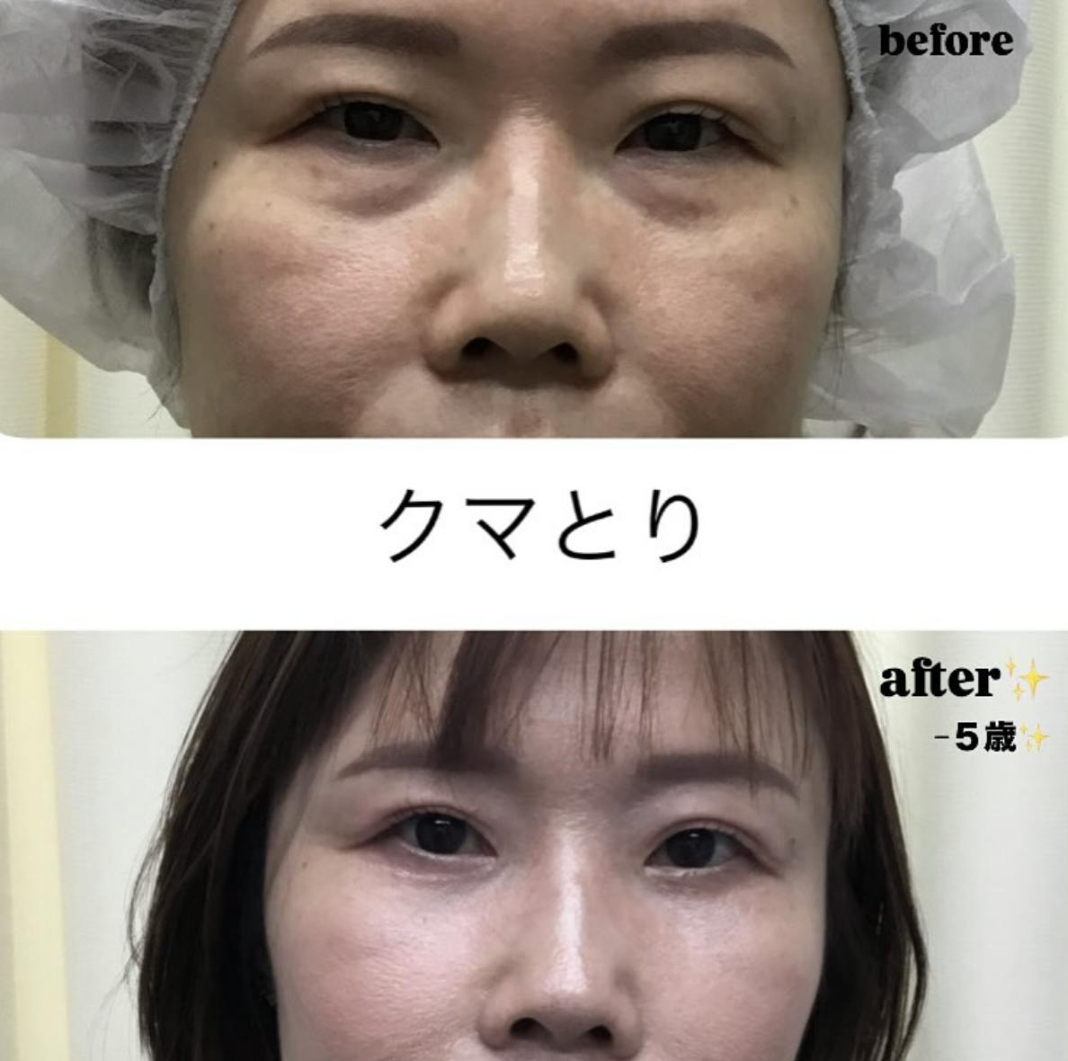 【女性・目元】クマ取り(経結膜脱脂)_before_aftar