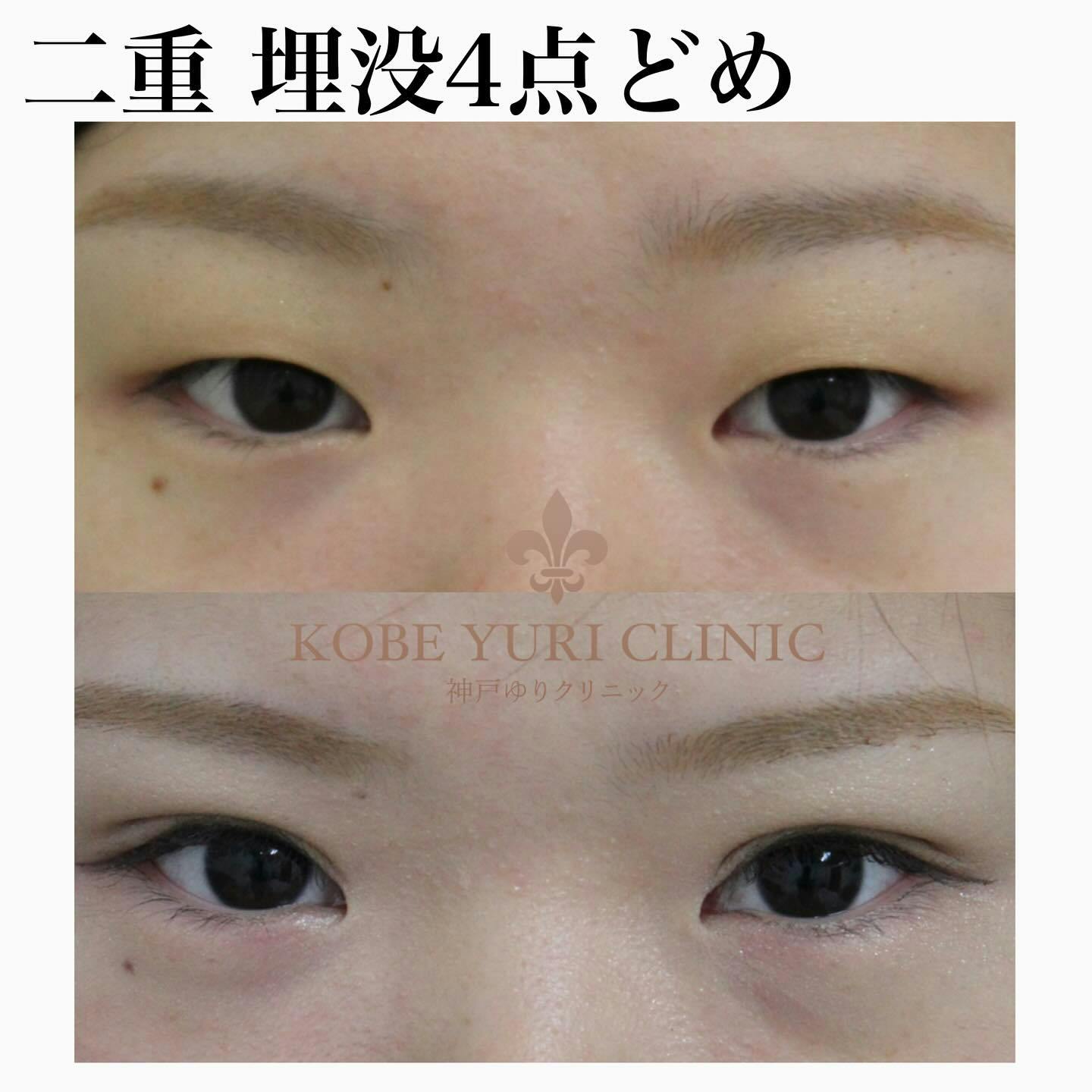 【女性・目元】二重埋没法 4点どめ_before_aftar
