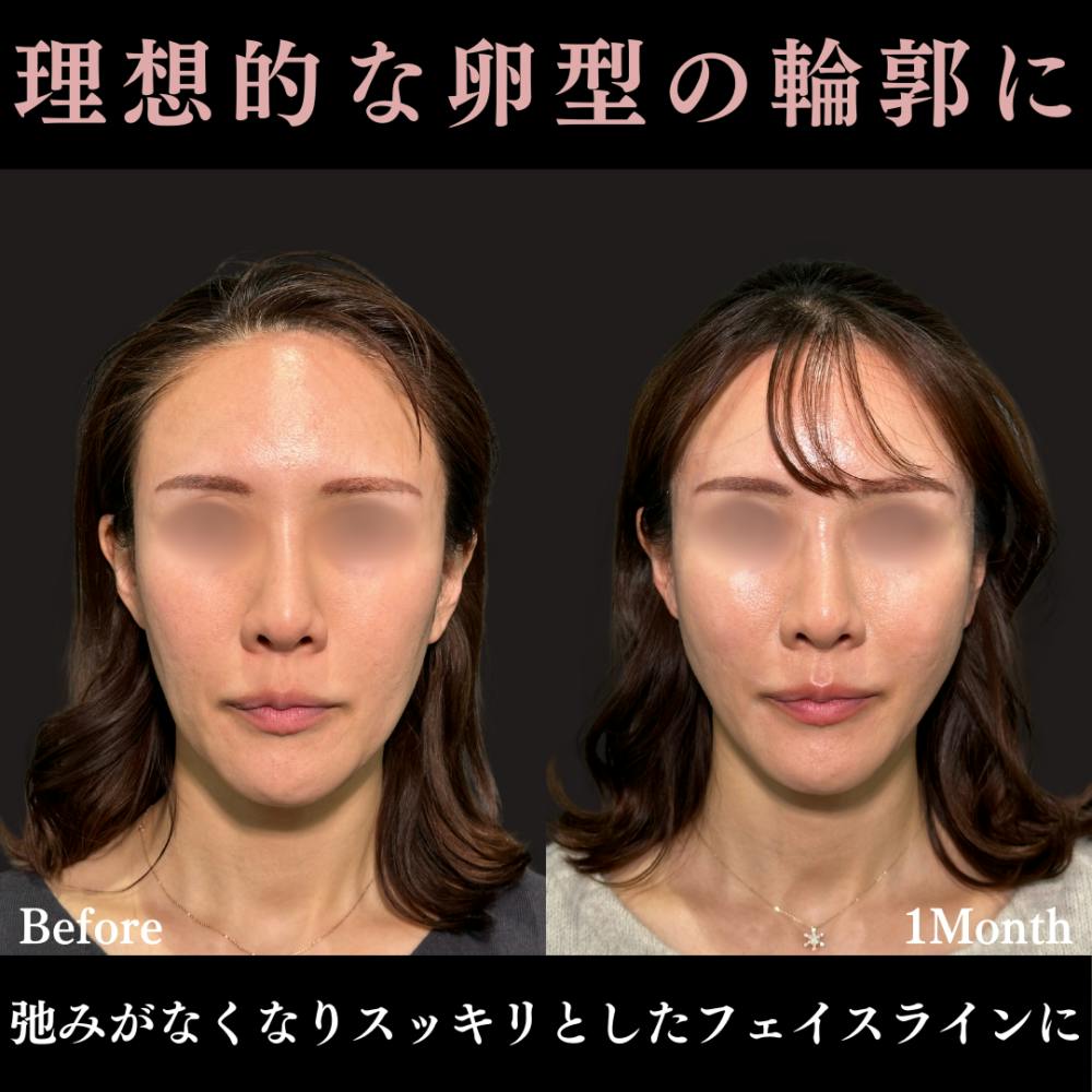 【40代女性・頬】ウルトラソフト＋ ヒアルロン酸注射（頬）_before_aftar