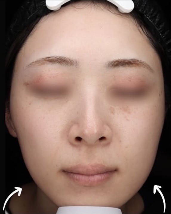 【女性・エラ】エラボトックス_a1