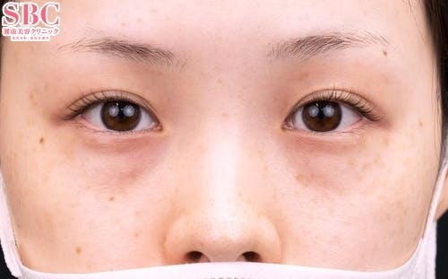 【20代女性・目元】ナチュラル脂肪注射コンデンスリッチ、目の下の切らないクマ・たるみ（ふくらみ）取り_before