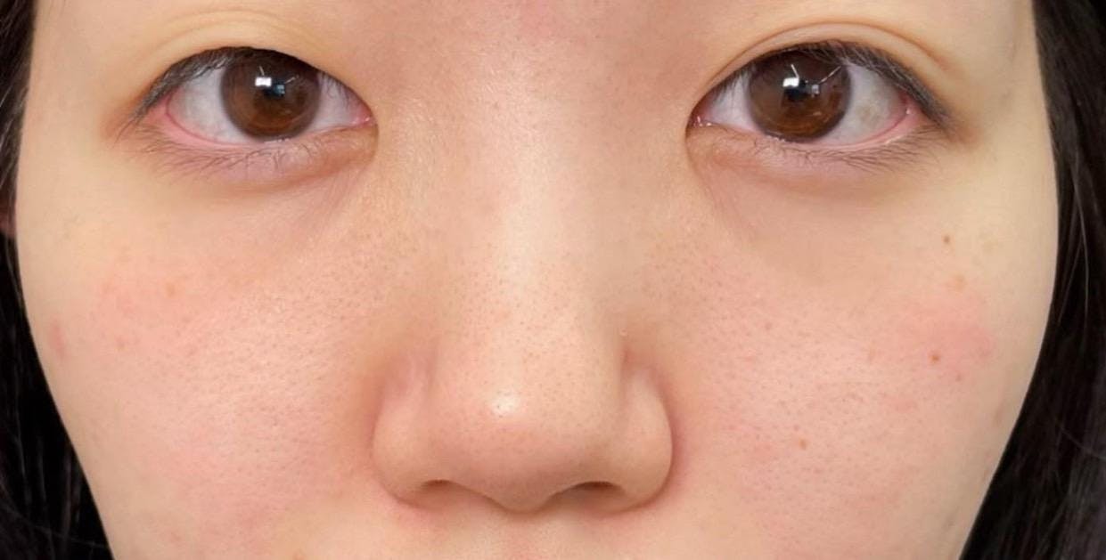 お茶の水美容形成クリニック お茶の水院(OCHANOMIZU BEAUTY CLINIC)で二重埋没法：ダブルスクエア法両目を受けたabeさんの写真