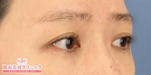 【女性・目元】タルミ取り併用全切開法二重、眼瞼下垂_before