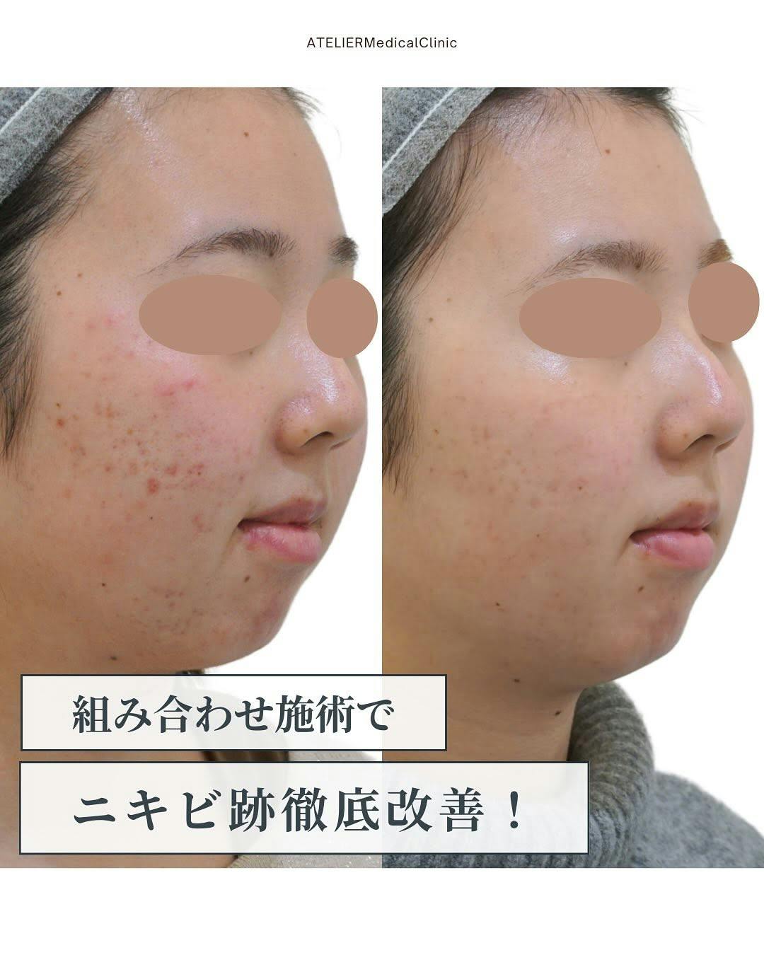 【女性・ニキビ跡】ジェネシス ダーマピールセレクション_before_aftar