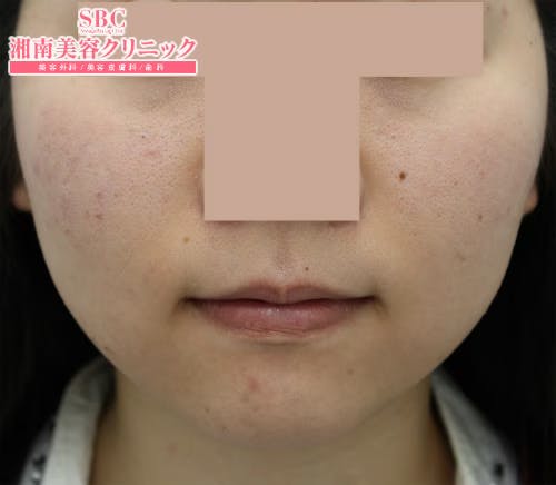 【女性・輪郭】美ボディ脂肪吸引_before