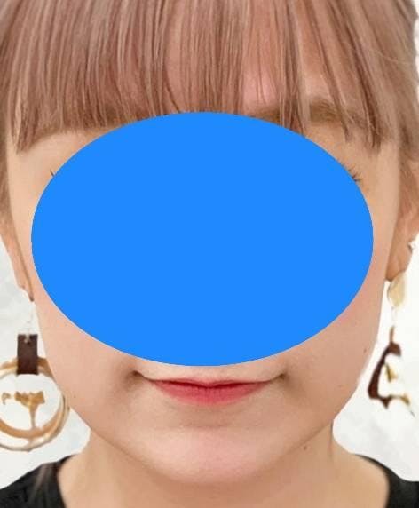 プリズムビューティークリニック(PRISM Beauty Clinic)で糸リフト(スレッドリフト)を受けた吹雪丸さんの写真