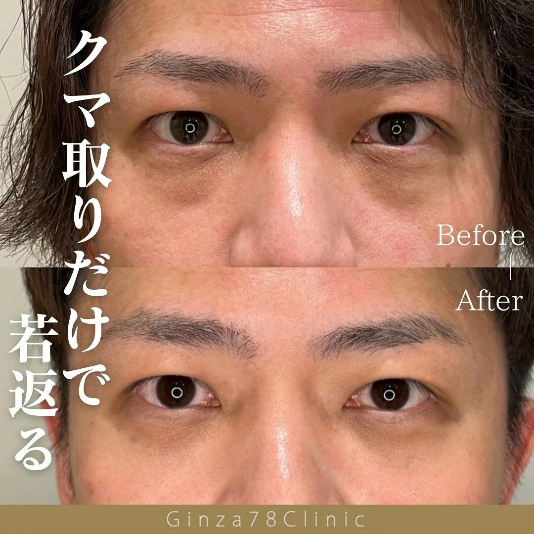 【男性・目元】目の下のクマ取り_before_aftar