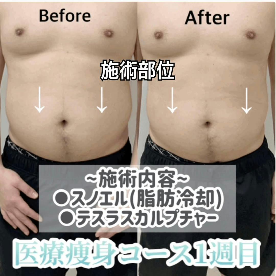 【男性・腹部】医療痩身ゴールドコース（スノエル(脂肪冷却)、テスラスカルプチャー）_before_aftar