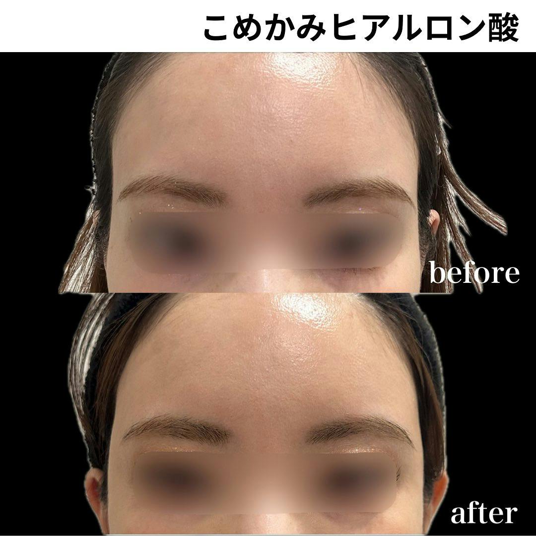【女性・こめかみ】ヒアルロン酸_before_aftar