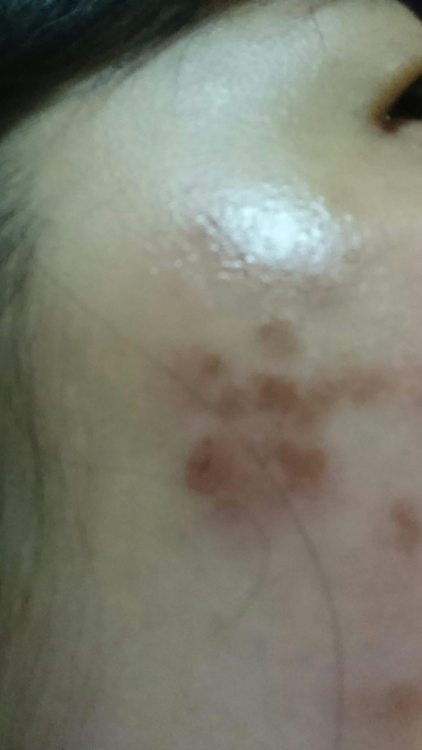 中野医院でピコレーザーを受けたtomomo1211さんの写真