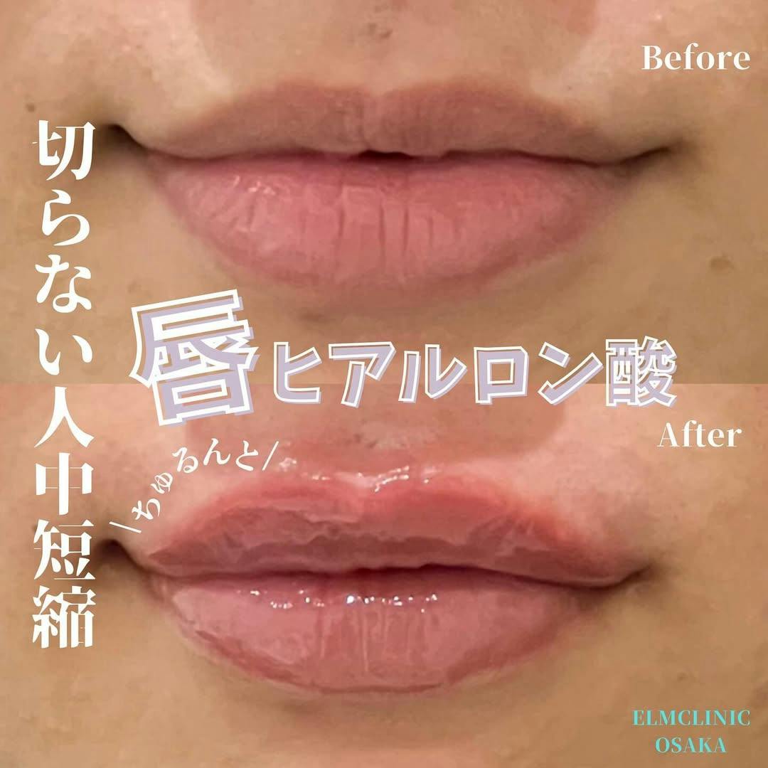 【女性・唇】ヒアルロン酸_before_aftar