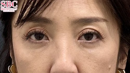 【50代女性・目元】ナチュラル脂肪注射コンデンスリッチ ナチュラル脂肪注射ナノリッチ 目の下の切らないクマ・たるみ（ふくらみ）取り_after