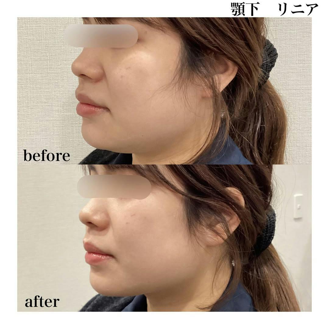 【女性・顎下】ウルトラセルQ＋リニア(HIFU)_before_aftar