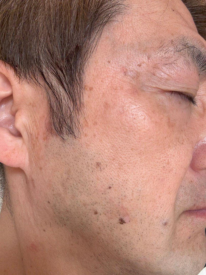 よつば会クリニック 森ノ宮院でシミ取り　顔を受けたhayabusaさんの写真