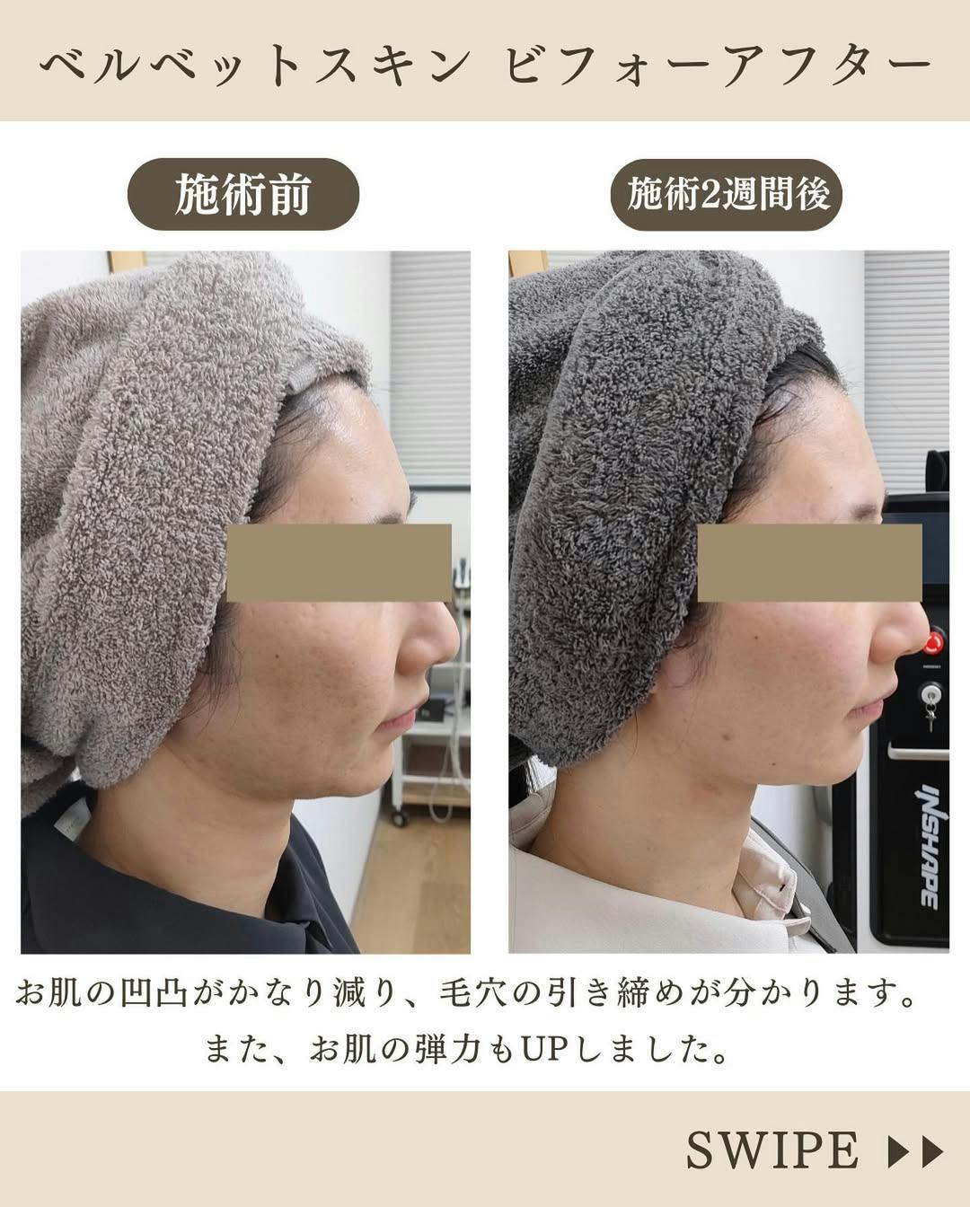 【女性・毛穴】ベルベットスキン_before_aftar