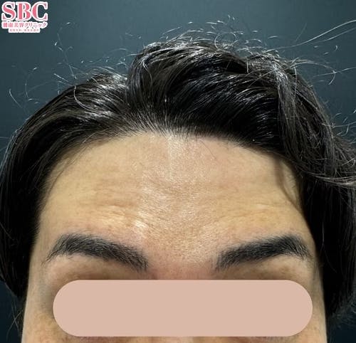 【30代男性・シワ】ボトックス（アラガン）_before