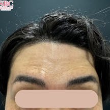 【30代男性・シワ】ボトックス(アラガン)_before