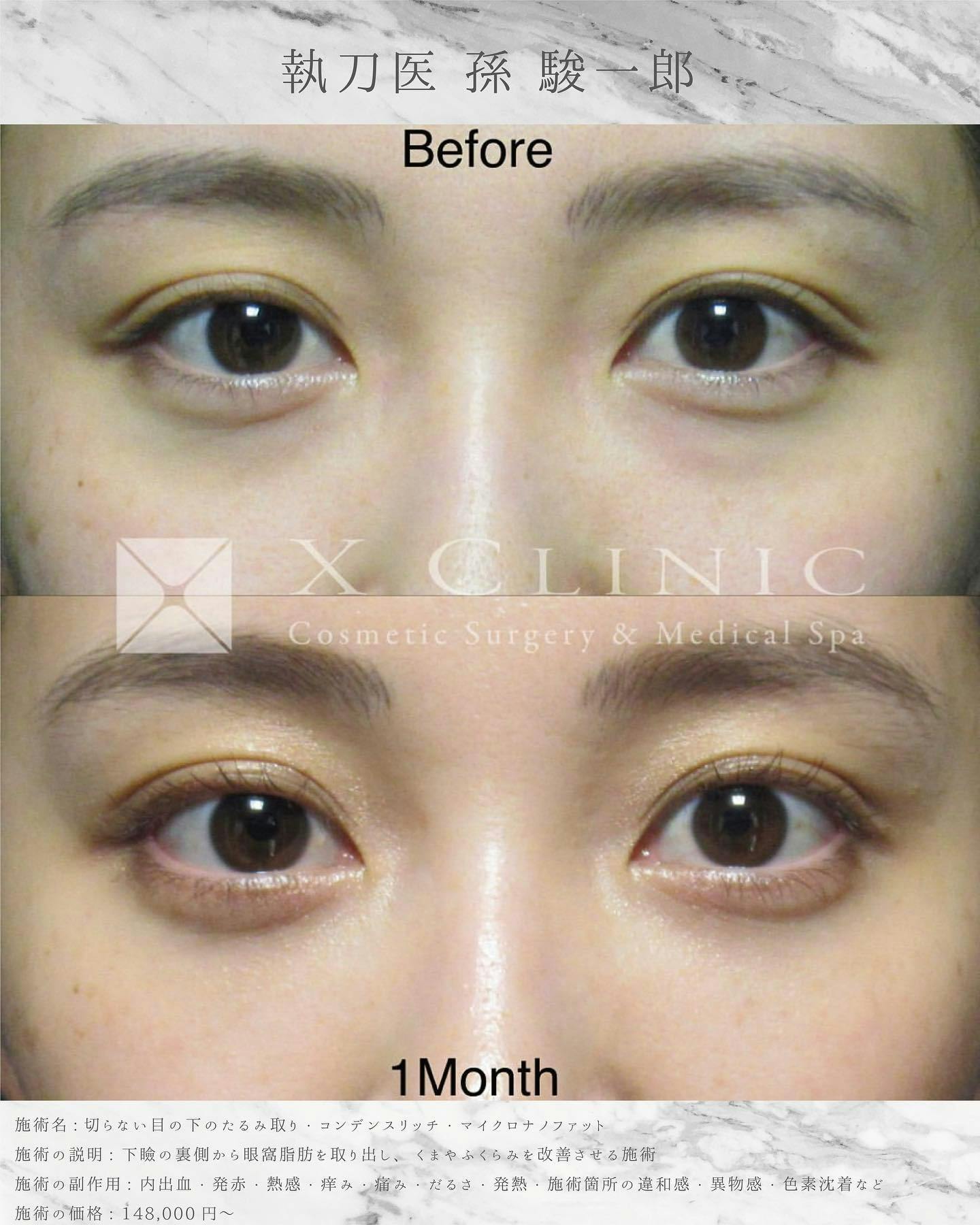 【女性・目元】クマ取りフルコース_before_aftar