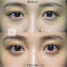 【女性・目元】クマ取りフルコース_before_aftar