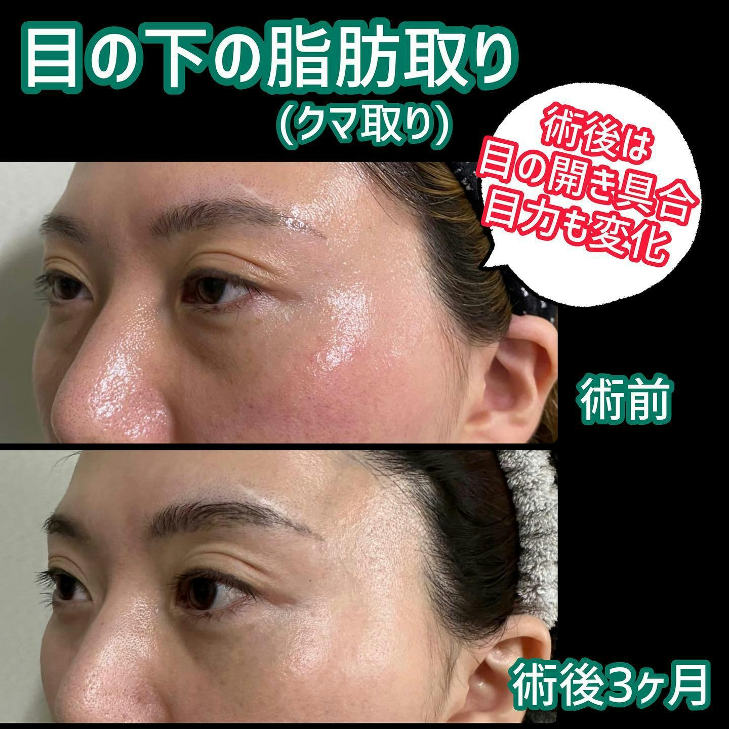 【女性・目元】目の下の脂肪取り（目のクマ取り）_before_aftar
