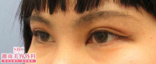 【女性・目元クイックコスメティーク・ダブルNeo・クイックコスメティーク・シングルNeo・目頭切開プレミアム_aftar