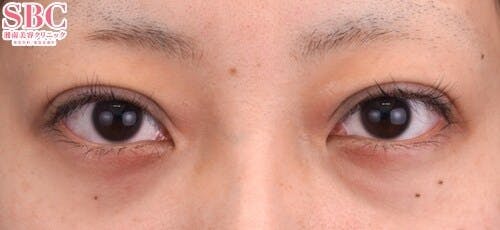 【20代女性・目元】クイックコスメティーク・トリプルNeo_0day