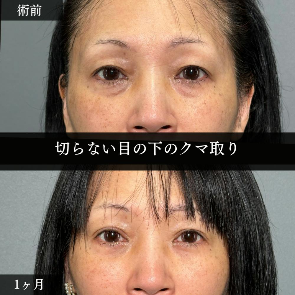 【50代女性・目】切らない目の下のクマ取り（経結膜脱脂術）_before_aftar
