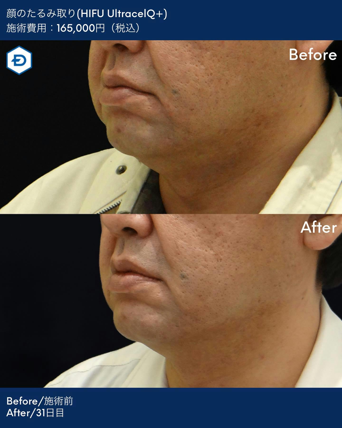 【男性・たるみ】顔のたるみ取り(HIFU UltracelQ+)_before_aftar
