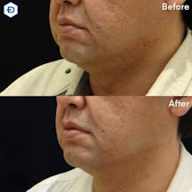 【男性・たるみ】顔のたるみ取り(HIFU UltracelQ+)_before_aftar
