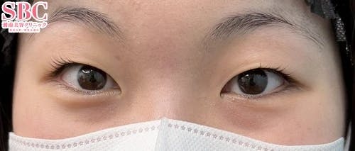【女性・目元】線留めクロス二重術_before