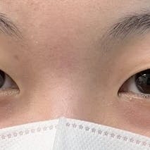 【女性・目元】線留めクロス二重術_before