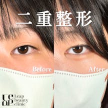 【10代女性・目元】二重埋没法_before_aftar