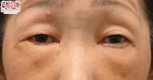 切開ハムラ(表ハムラ)法、ナチュラル脂肪注射ナノリッチ_1week