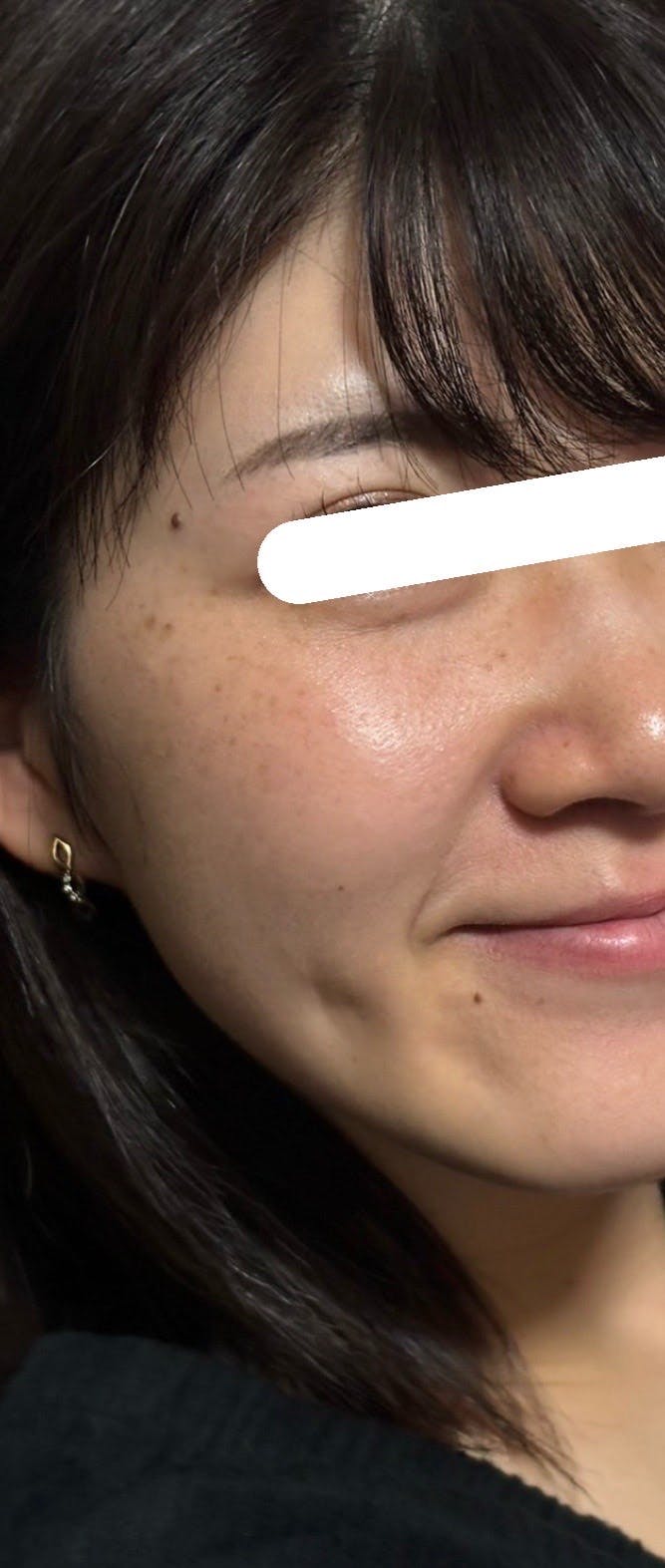 渋谷美容外科クリニック 渋谷院で目の下のクマ・たるみ取りを受けたerinaさんの写真