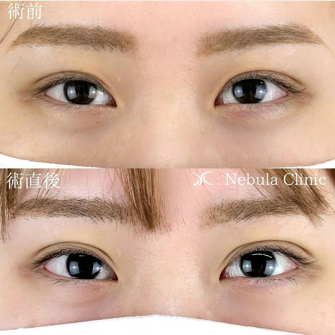 【女性・目元】二重埋没法_before_aftar