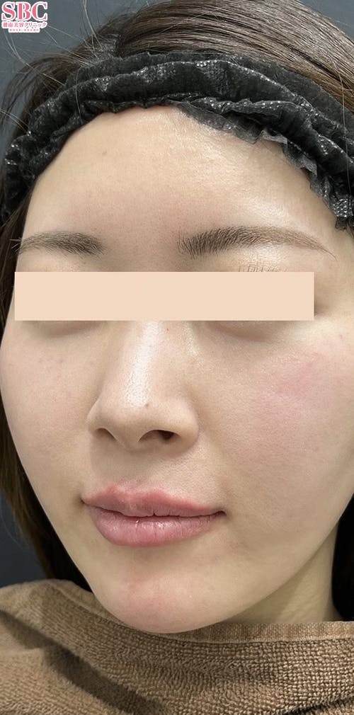 【女性・顎】ヒアルロン酸ジュビダームビスタ バイクロスシリーズ_after