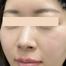 【女性・顎】ヒアルロン酸ジュビダームビスタ バイクロスシリーズ_after