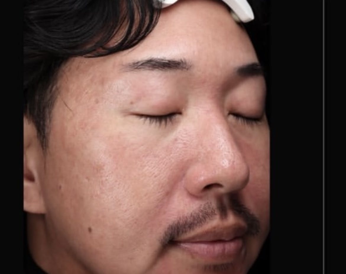 【男性・赤み鎮静】リジュメソ_b1